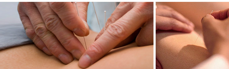Acupuncture for Back Pain at Oxford Osteopathy and Sports Injury Clinic